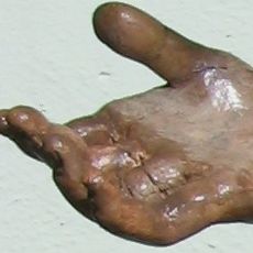 Hand nach Restauration